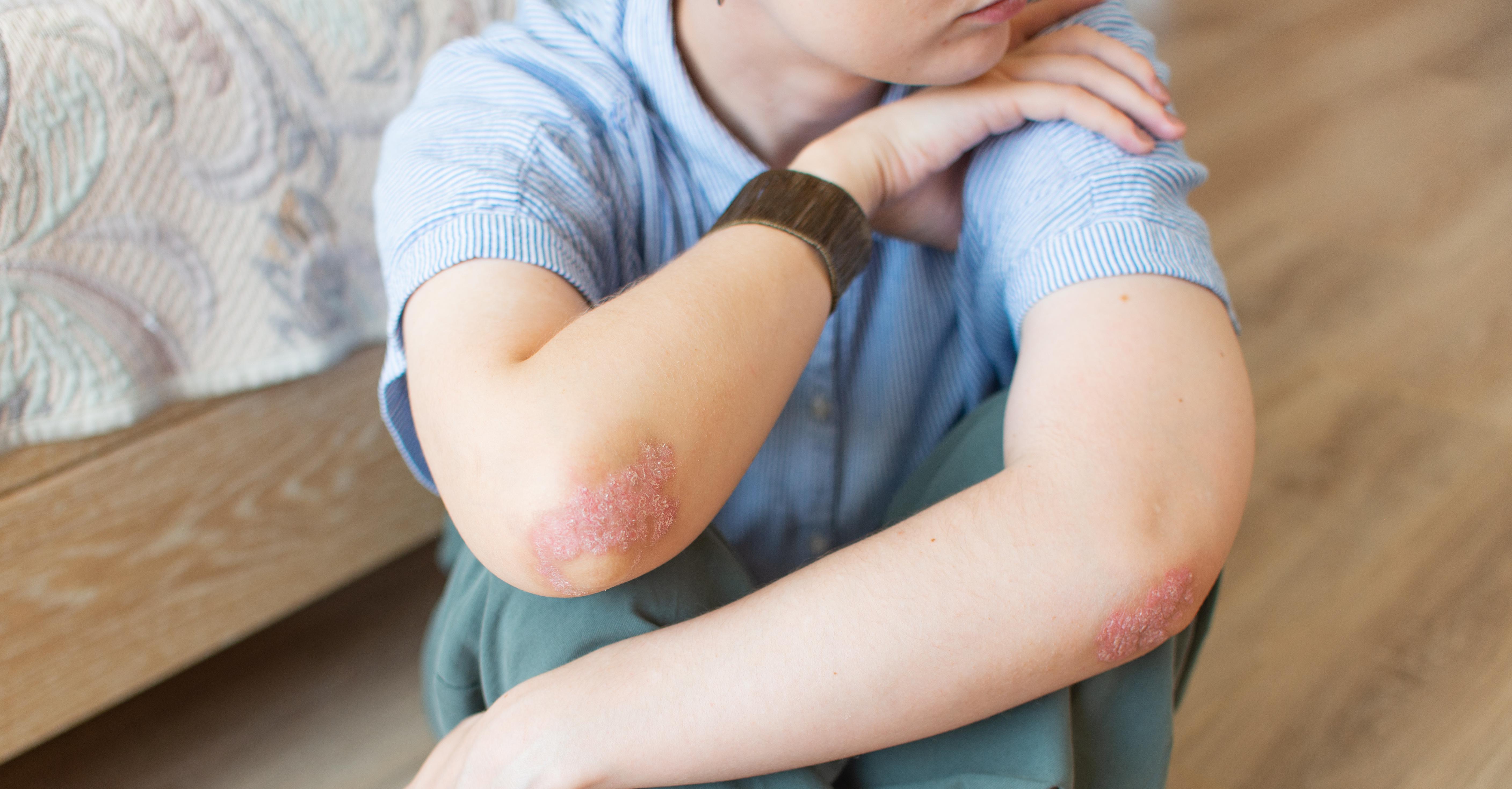 Your Guide to Understanding and Treating Plaque Psoriasis Twill Care